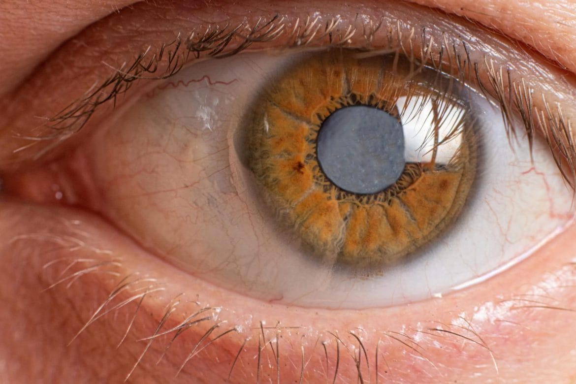 Picture of an eye with cataract