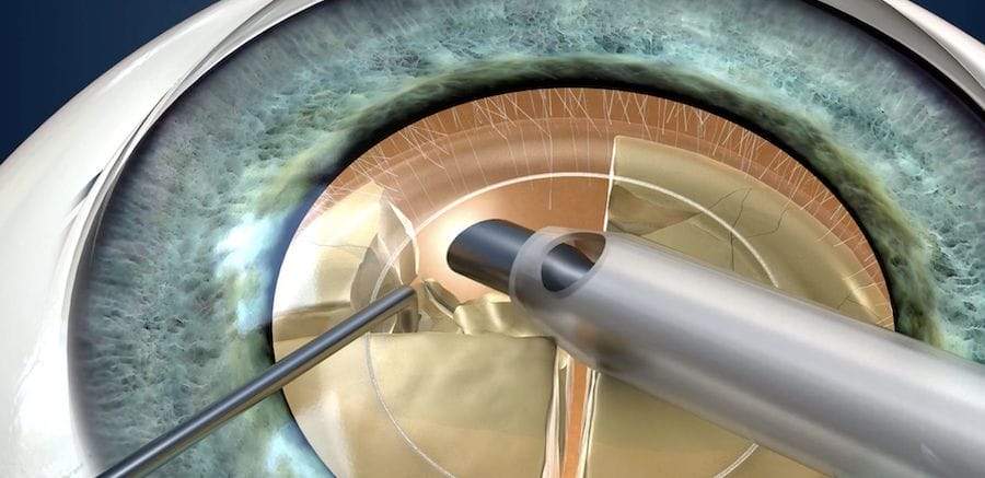 Picture of cataract surgery performed in Melbourne