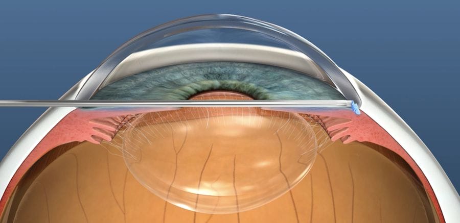 Minimally Invasive Glaucoma Surgery (MIGS) | Dr Nathan Kerr