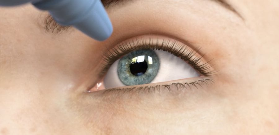 An eye drop being instilled for the treatment of glaucoma