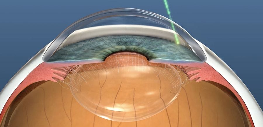 selective-laser-trabeculoplasty-slt-glaucoma-treatment-dr-nathan-kerr