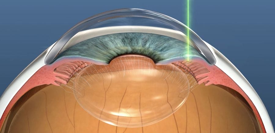 laser-peripheral-iridotomy-treat-angle-closure-glaucoma-dr-nathan-kerr